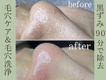 ティーツリー 名古屋 桜山(Tea Tree)/90分で毛穴の黒ずみが取れる