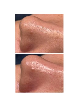 ディシェーレ アスト/ハイドロフェイシャル