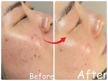 エレ(ele)/【施術1回】赤みニキビ改善ハ-ブ