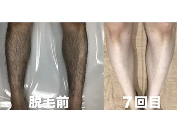 ビューティーサロンレモン(Lemon)/足脱毛