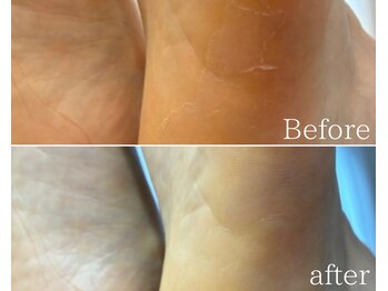 カシェット 広島店(Cachette)/50代女性☆足裏角質ケア60分