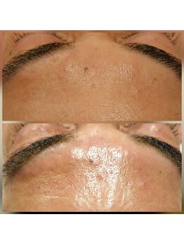 カルナボディ(Carna body.)/初回でツヤ肌♪ハーブピーリング