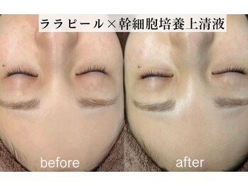 シエル ブルー(Ciel Blue)/ヒト幹細胞上清液(エクソソーム)