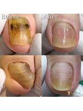 巻き爪補正店 姫路店/変形爪