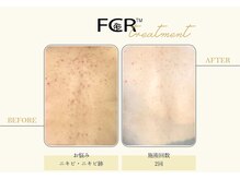 サロンアン(Salon an)/肌質改善にFCRハーブピーリング