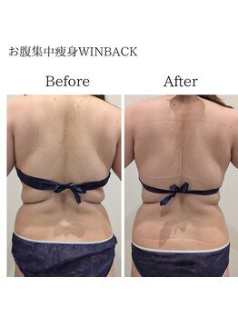 セルノヴァ(Cell Nova)/お腹/痩身/痩身ダイエット