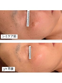 ミニョン(Mignon)/スタッフ周のシミ改善写真