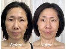 ドクターボディ 新宿店(Dr.Body)/【たるみ/顔の大きさ　50代】