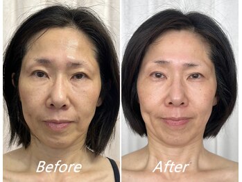 ドクターボディ 新宿店(Dr.Body)/【たるみ/顔の大きさ 50代】