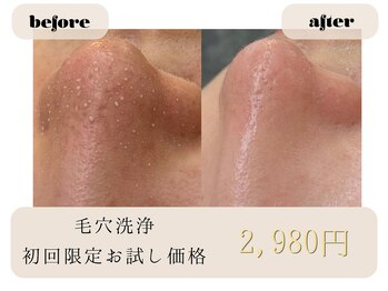 サロン アンネ(Anne)の写真/繰り返すニキビやザラつき毛穴といちご鼻を丁寧にケア!理想のなめらか肌を目指す旅♪