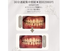 プラスビーセルフ(+b self)/ホワイトニングビフォーアフター