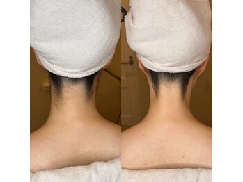 リンド エステ まつげ 京成大久保(Lind)/襟足シェービング