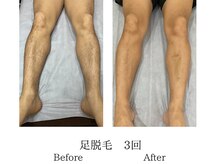 メンズミーシェ(Men's Meshie)/ひざ下脱毛施術前