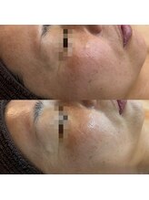 ココリール/毛穴洗浄×光フェイシャル