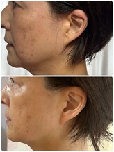 ウィッシュプロサロンケー(WISHpro salon K)/マリオネットライン撃退！