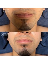 カナウ(KANAU)/ヒゲ脱毛（20代前半男性）