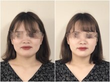 オーレ 秋葉原店(ole)/【小顔矯正】ビフォアアフター
