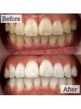 LBSホワイトニング 上野店/ホワイトニングビフォーアフター