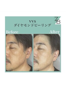 ザラハビューティー(ZARAHA Beauty)/VVSダイヤモンドピーリング
