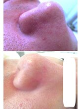 サロンドエステケイワイ(de KY)/フェイシャル☆ニキビ改善