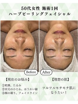 シーフェイス 横浜店(SEE FACE)/毛穴くすみケアハーブピーリング