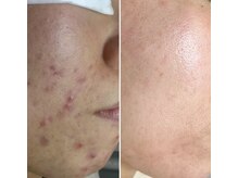 ディンプル(Dimple)/ニキビケア