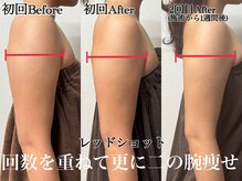 アンドエス 六本木(and S.)/回数を重ねて更に脂肪スッキリ♪