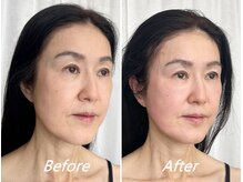 ドクターボディ 新宿店(Dr.Body)/【顔の長さを短く　50代】