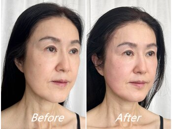 ドクターボディ 新宿店(Dr.Body)/【顔の長さを短く 50代】