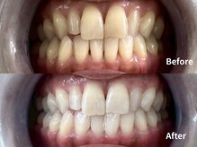 ホワイトニングショップ 福岡姪浜店の雰囲気（ホワイトニング5~10回の施術でこの白さまでいきます※個人差あり）