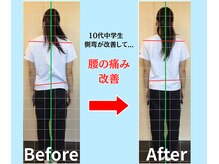 ソヴァール(SAUVEUR)/15歳中学生の側弯
