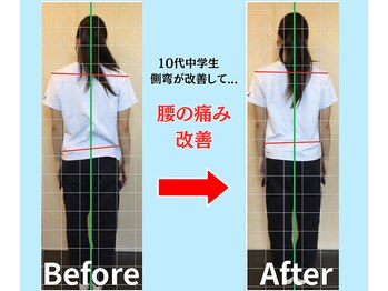 ソヴァール(SAUVEUR)/15歳中学生の側弯