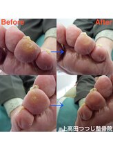上高田つつじ整体院/フットケア　角質ケア　魚の目　