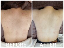 ハーブピーリング 心斎橋/背中ニキビ改善