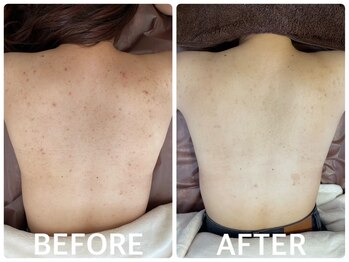 ハーブピーリング 心斎橋/背中ニキビ改善