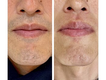 ブロウブロウ(Blow Brow)/ヒゲ脱毛