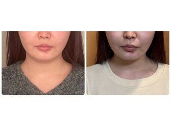 小顔矯正サロン ブルーム/顎がシュッ!