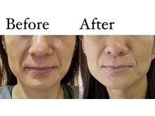 サロン ヌーク(salon Nook)/ほうれい線のケア