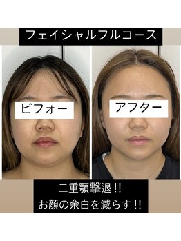 エミナル(EMINARU)/機械でお顔の痩身+小顔矯正