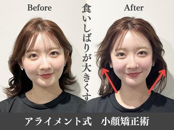アライメントトウキョウ 表参道(Alignment TOKYO)/気になるフェイスライン改善♪
