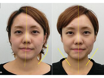 宮崎整体院/【小顔矯正・顔の歪み矯正】