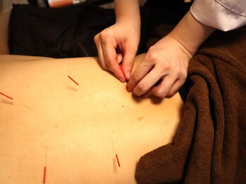 オータム(Autumn)の写真/身体の状態・お悩みに合わせて鍼の深さ/本数/刺激を調整する【オーダーメイド鍼】刺激の少ないやさしい鍼♪