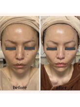 リリー ボヌール(Lily bonheur)/ソニックリフトトリートメント