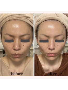 リリー ボヌール(Lily bonheur)/ソニックリフトトリートメント