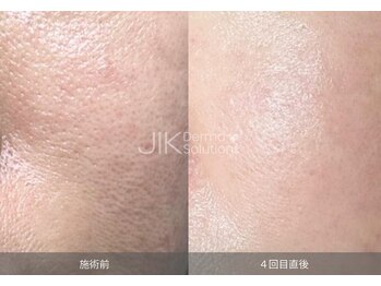 ナチュウル(Natulu)/ララピール進化版！ダクトピール