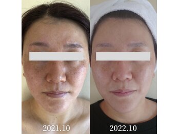 エステサロンブランシュ(Esthe salon Blanche)/ハーブとホームケアで…