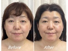 ドクターボディ 新宿店(Dr.Body)/【顎のもたつき/たるみ　50代】