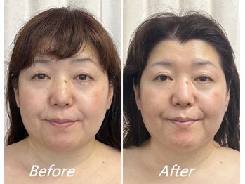 ドクターボディ 新宿店(Dr.Body)/【顎のもたつき/たるみ 50代】