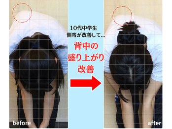 ソヴァール(SAUVEUR)/15歳中学生の側弯