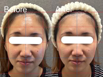 ヘレフア(Hele Hua)の写真/≪NewOpen≫左右差やエラ張りの悩みも解消!痛みの少ない!"造顔技術"で理想のフェイスラインを◎新琴似/麻生